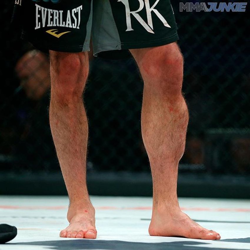 Кадр дня: Голень Рори МакДональда после турнира Bellator 192