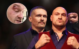 Экс-тренер Дюбуа назвал причину рассечения у Тайсона Фьюри перед боем с Александром Усиком
